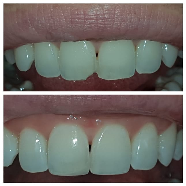 Composite Bonding Before and After